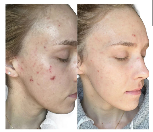 X FORMULATION -LED AT HOME MASK